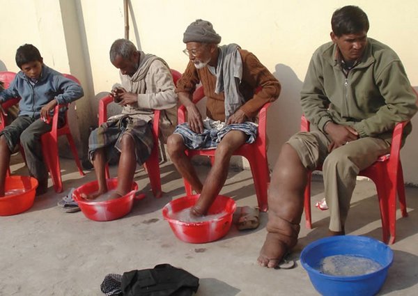 Lymphatic filariasis is one of the NTDs the new WHO initiative focuses on.<br/>Photo:© Centre for Neglected Tropical Diseases